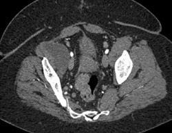 Synovial Cyst Right Hip - CTisus CT Scan