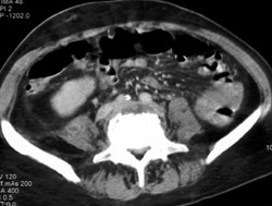 Infected L5-s1 With Paraspinal Abscess - CTisus CT Scan