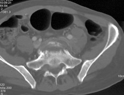 Osteomyelitis - CTisus CT Scan