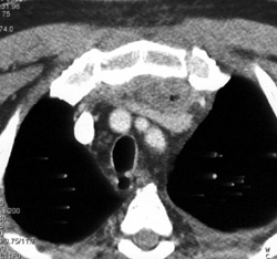 Mediastinal Abscess - CTisus CT Scan