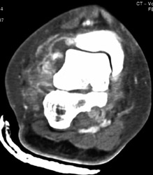 Ankle Joint Effusion - CTisus CT Scan