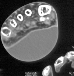 Abscess - CTisus CT Scan