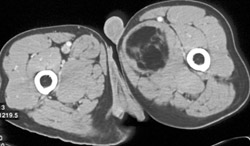 Liposarcoma - CTisus CT Scan