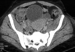 Infected Left SI Joint With Iliopsoas Abscess - CTisus CT Scan