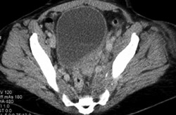 Left SI Joint Infected With Iliopsoas Abscess - Musculoskeletal Case ...