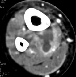 Intramuscular Abscess - CTisus CT Scan