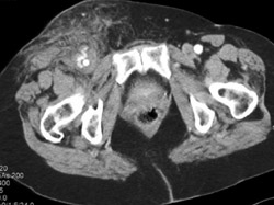 Active Bleed With Hematoma in Right Groin - CTisus CT Scan