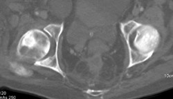 Avascular Necrosis (AVN) - CTisus CT Scan