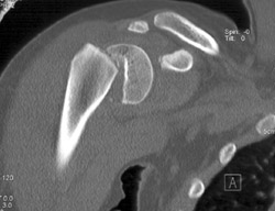 Humerus Fracture Through Epiphyseal Plate - CTisus CT Scan