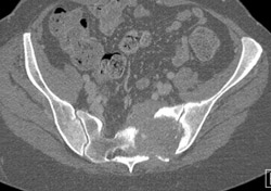 Metastatic Renal Cell Carcinoma - CTisus CT Scan