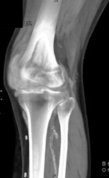 Synovial Hypertrophy - CTisus CT Scan