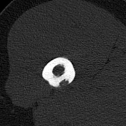 Benign Fibrous Lesion - CTisus CT Scan