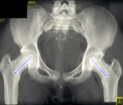 Bilateral Hip Pinning - CTisus CT Scan