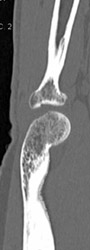 Radial Head Fracture - CTisus CT Scan