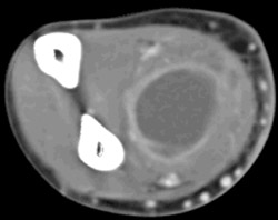 Intramuscular Abscess - CTisus CT Scan