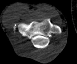 Intra-articular Fragments - CTisus CT Scan