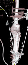 Tibial Fractures - CTisus CT Scan