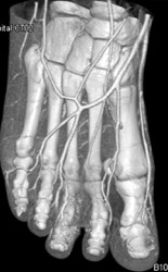 CTA of the Foot - CTisus CT Scan