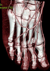 CTA of the Foot With Inflamed 3rd Digit - CTisus CT Scan