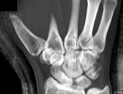 Healing Scaphoid Fracture - CTisus CT Scan