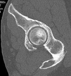 Acetabular Fracture - CTisus CT Scan