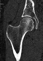 Acetabular Fracture - CTisus CT Scan