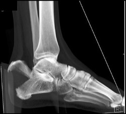 Fracture of the Calcaneus - CTisus CT Scan