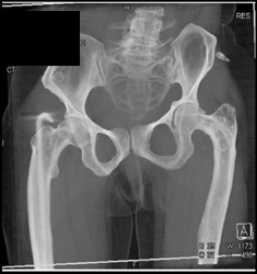 Osteogenesis Imperfecta - CTisus CT Scan