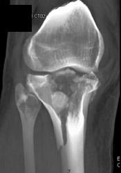 Tibial Plateau Fracture - CTisus CT Scan