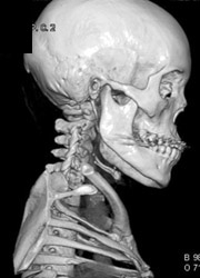 VRT of the Face - CTisus CT Scan