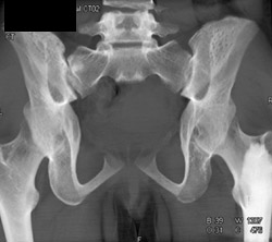 Prior Bone Marrow Harvesting in Iliac Bones - CTisus CT Scan