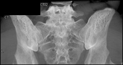 Prior Bone Marrow Harvesting - CTisus CT Scan