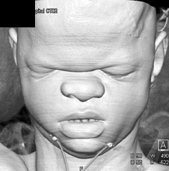 Alport Syndrome - CTisus CT Scan