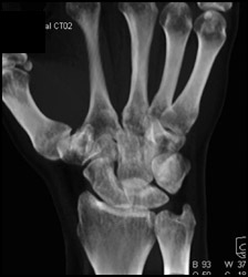 Subtle Scaphoid Fracture - CTisus CT Scan