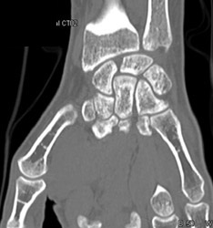 Scaphoid Fracture - CTisus CT Scan