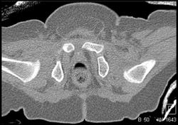 Non-reduced Left Hip in Spica Cyst - CTisus CT Scan