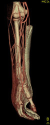 CTA Angiogram of the Arm - CTisus CT Scan