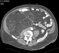 Liposarcoma - CTisus CT Scan