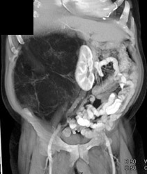 Liposarcoma - CTisus CT Scan