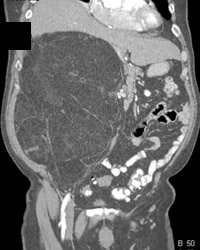 Liposarcoma - CTisus CT Scan