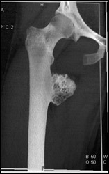 Chondrosarcoma - CTisus CT Scan