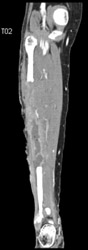 CTA With Abscess Post Bone Harvesting - CTisus CT Scan