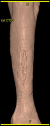 Skin Wound - CTisus CT Scan