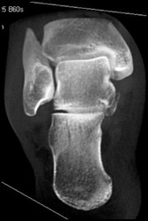 Talus Fracture - CTisus CT Scan