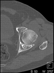 Enchondroma - CTisus CT Scan