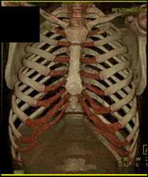 Normal Chest Wall - CTisus CT Scan