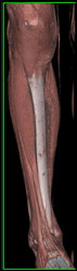 Normal Calf - CTisus CT Scan