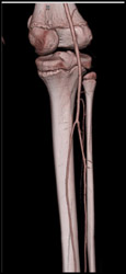 Normal Trifurcation - CTisus CT Scan