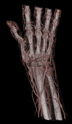 CTA Hand - CTisus CT Scan