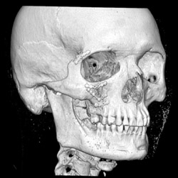 Post Orbital Fracture Repair - CTisus CT Scan